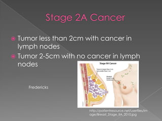 Stage 2A CancerTumor less than 2cm with cancer in lymph nodesTumor 2-5cm with no cancer in lymph nodesFrederickshttp://patientresource.net/userfiles/image/Breast_Stage_IIA_2010.jpg
