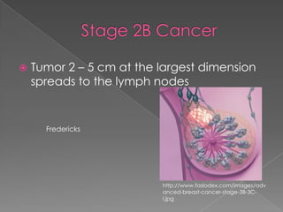Stage 2B CancerTumor 2 – 5 cm at the largest dimension spreads to the lymph nodes Frederickshttp://www.faslodex.com/images/advanced-breast-cancer-stage-3B-3C-l.jpg