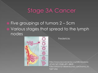 Stage 3A CancerFive groupings of tumors 2 – 5cm Various stages that spread to the lymph nodesFrederickshttp://www.bccancer.bc.ca/NR/rdonlyres/E74D74FF-9D8E-4FF1-8B39-92E61EFE5310/18064/ductal_carcinoma_range1.jpg