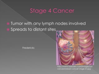 Stage 4 CancerTumor with any lymph nodes involvedSpreads to distant sitesFrederickshttp://www.faslodex.com/images/advanced-breast-cancer-stage-4-l.jpg