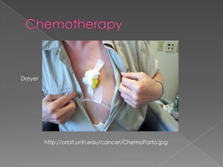Chemotherapy Dreyerhttp://orbit.unh.edu/cancer/ChemoPorta.jpg