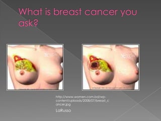 What is breast cancer you ask?http://www.women.com.bd/wp-content/uploads/2008/07/breast_cancer.jpgLaRusso