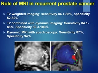Role of MRI in recurrent prostate cancer
 T2 weighted imaging: sensitivity 84.1-88%, specificity
52-82%
 T2 combined wit...