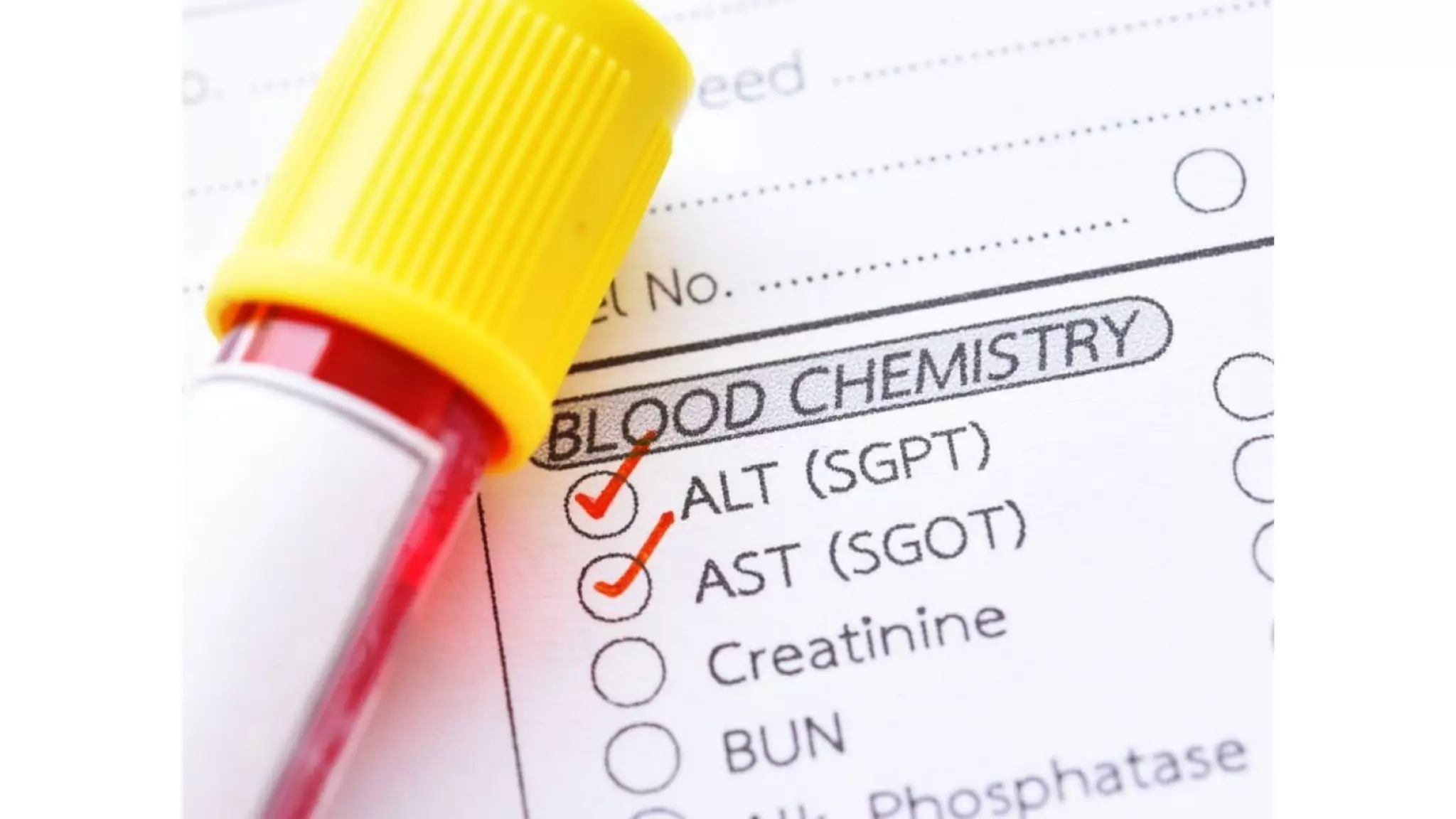 SGPT Normal Range - Redcliffe Labs.pdf