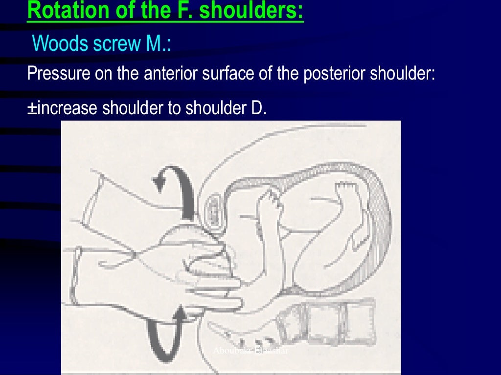 Shoulder dystocia