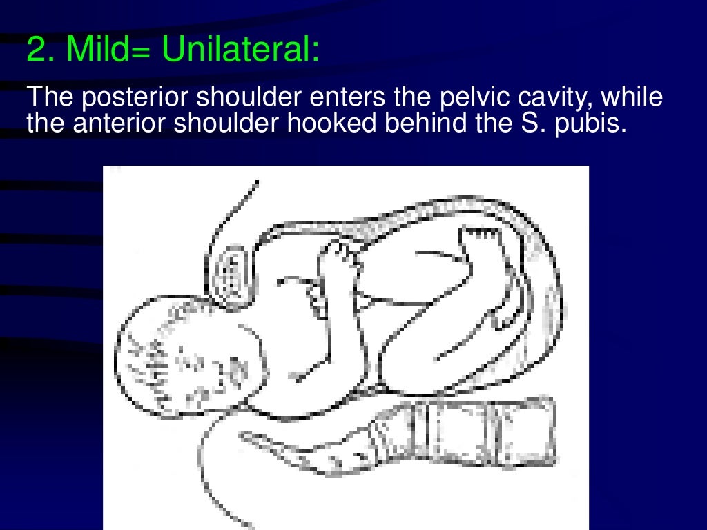 Shoulder dystocia
