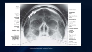 Anatomical Landmarks in Waters Position
 