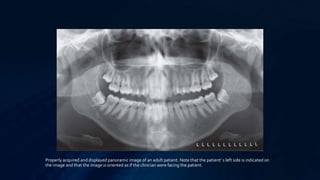 Properly acquired and displayed panoramic image of an adult patient. Note that the patient’ s left side is indicated on
the image and that the image is oriented as if the clinician were facing the patient.
 