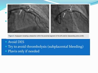 ESC guidelines on Cardiovascular diseases during pregnancy | PPTX