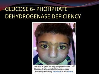 GLUCOSE 6- PHOHPHATE
DEHYDROGENASE DEFICIENCY
 