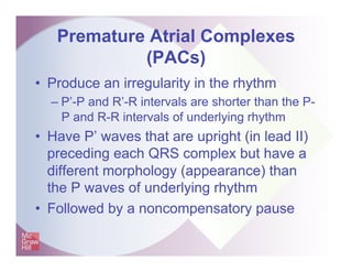 Premature Atrial Complexes
(PACs)
• Produce an irregularity in the rhythm
– P’-P and R’-R intervals are shorter than the P...