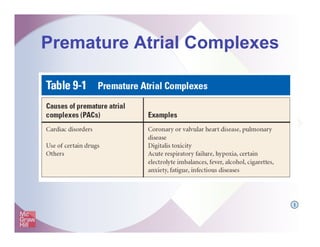 Premature Atrial Complexes
I
 