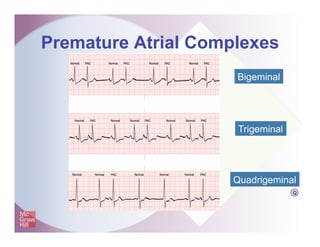Premature Atrial Complexes
Q
Bigeminal
Trigeminal
Quadrigeminal
 