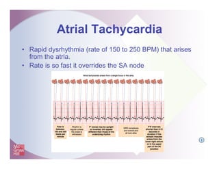 Atrial Tachycardia
• Rapid dysrhythmia (rate of 150 to 250 BPM) that arises
from the atria.
• Rate is so fast it overrides...