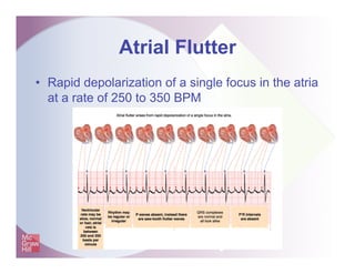 Atrial Flutter
• Rapid depolarization of a single focus in the atria
at a rate of 250 to 350 BPM
 