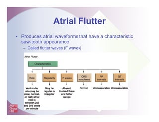 Atrial Flutter
• Produces atrial waveforms that have a characteristic
saw-tooth appearance
– Called flutter waves (F waves)
 