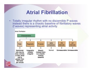 Atrial Fibrillation
• Totally irregular rhythm with no discernible P waves
instead there is a chaotic baseline of fibrilla...