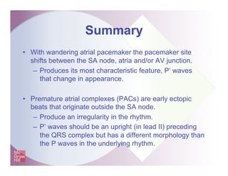 Summary
• With wandering atrial pacemaker the pacemaker site
shifts between the SA node, atria and/or AV junction.
– Produ...