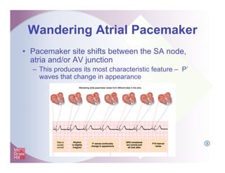Wandering Atrial Pacemaker
• Pacemaker site shifts between the SA node,
atria and/or AV junction
– This produces its most ...