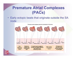 Premature Atrial Complexes
(PACs)
• Early ectopic beats that originate outside the SA
node
 