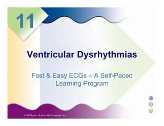 Q
I
A
11
Fast & Easy ECGs – A Self-Paced
Learning Program
Ventricular Dysrhythmias
 