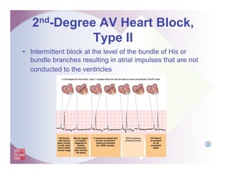 2nd-Degree AV Heart Block,
Type II
•  Intermittent block at the level of the bundle of His or
bundle branches resulting in atrial impulses that are not
conducted to the ventricles
I
 