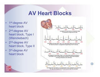 AV Heart Blocks
•  1st-degree AV
heart block
•  2nd-degree AV
heart block, Type I
(Wenckebach)
•  2nd-degree AV
heart block, Type II
•  3rd-degree AV
heart block
I
 