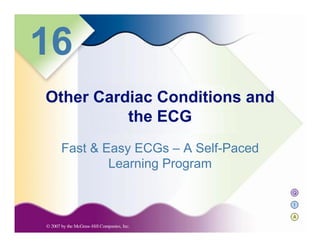 Q
I
A
16
Fast & Easy ECGs – A Self-Paced
Learning Program
Other Cardiac Conditions and
the ECG
 