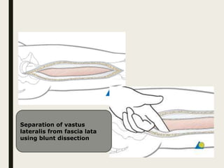 Separation of vastus
lateralis from fascia lata
using blunt dissection
 