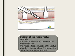 Incision of the fascia vastus
lateralis
The vastus lateralis is now retracted
anteromedially.
The muscle fascia investing the vastus
lateralis is incised about 1 cm anterior
to the intermuscular septum
 