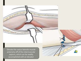 Elevate the vastus lateralis muscle
anteriorly off of the intermuscular
septum, which can be readily
accomplished with an elevator
 