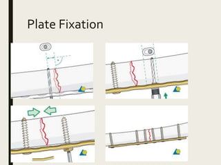 Plate Fixation
 