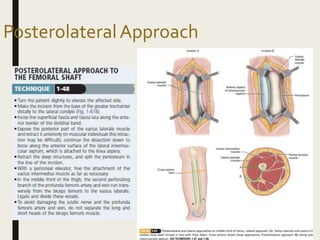 PosterolateralApproach
 