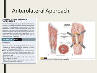 AnterolateralApproach
 