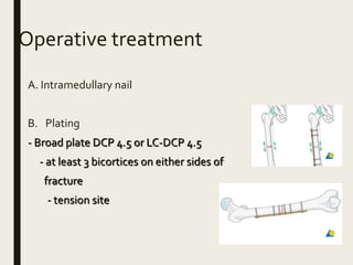 Operative treatment
A. Intramedullary nail
B. Plating
- Broad plate DCP 4.5 or LC-DCP 4.5
- at least 3 bicortices on either sides of
fracture
- tension site
 
