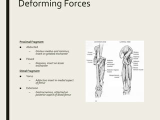 Deforming Forces
Proximal Fragment
■ Abducted
– Gluteus medius and minimus,
insert on greated trochanter
■ Flexed
– Iliopsoas, insert on lesser
trochanter
Distal Fragment
■ Varus
– Adductors insert in medial aspect
of femur
■ Extension
– Gastrocnemius, attached on
posterior aspect of distal femur
 