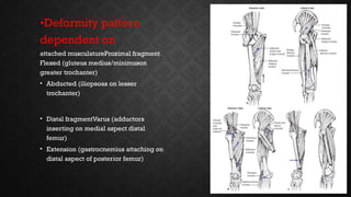 Comprehensive Management of Femoral Shaft Fractures: Anatomy ...