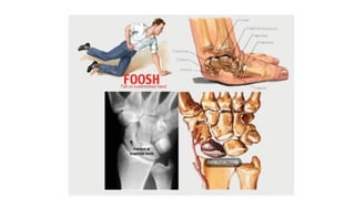 shahab '24 JC Colle's fracture [Autosaved].pptx