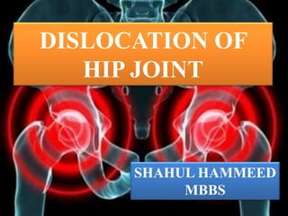 DISLOCATION OF
HIP JOINT
SHAHUL HAMMEED
MBBS
 