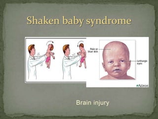 Shaken baby syndrome




         Brain injury
 