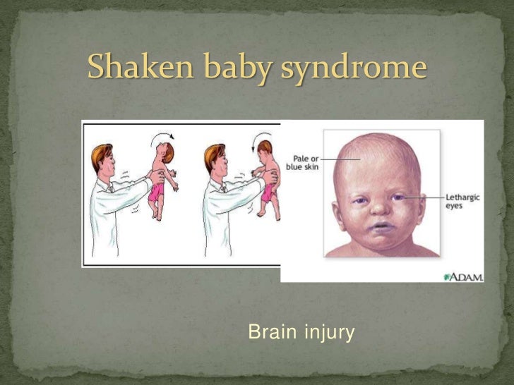 Shaken baby syndrome symptoms later in life