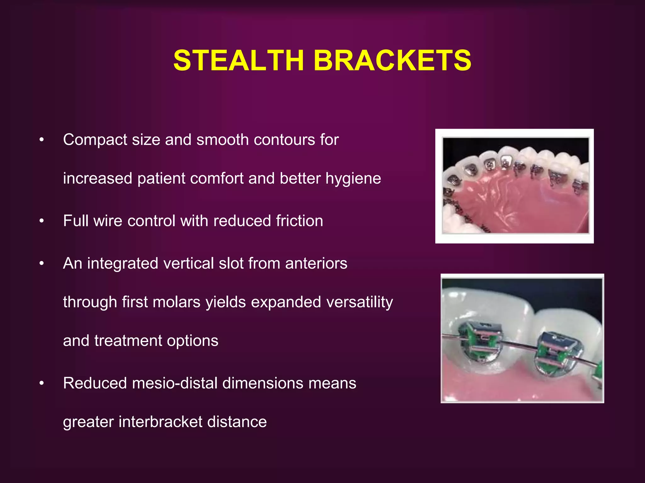 STEALTH BRACKETS
• Compact size and smooth contours for
increased patient comfort and better hygiene
• Full wire control with reduced friction
• An integrated vertical slot from anteriors
through first molars yields expanded versatility
and treatment options
• Reduced mesio-distal dimensions means
greater interbracket distance
 