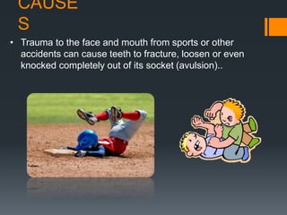 CAUSE
S
• Trauma to the face and mouth from sports or other
accidents can cause teeth to fracture, loosen or even
knocked completely out of its socket (avulsion)..
 