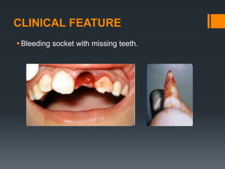 CLINICAL FEATURE
Bleeding socket with missing teeth.
 