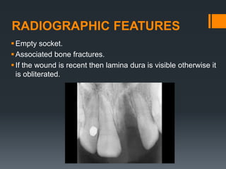 RADIOGRAPHIC FEATURES
Empty socket.
Associated bone fractures.
If the wound is recent then lamina dura is visible otherwise it
is obliterated.
 