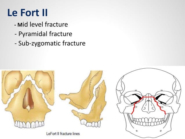 Middle Third Overbite Fractures of middle third of face | PPTX | Death, Injury, or Military ...