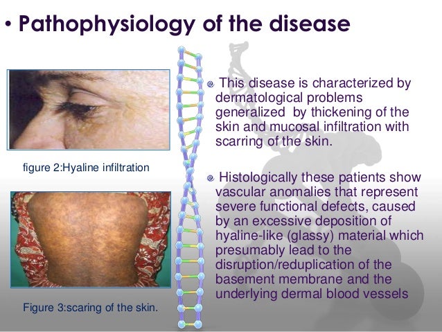 Urbach-Wiethe Syndrome Associated Fear Processing Defect