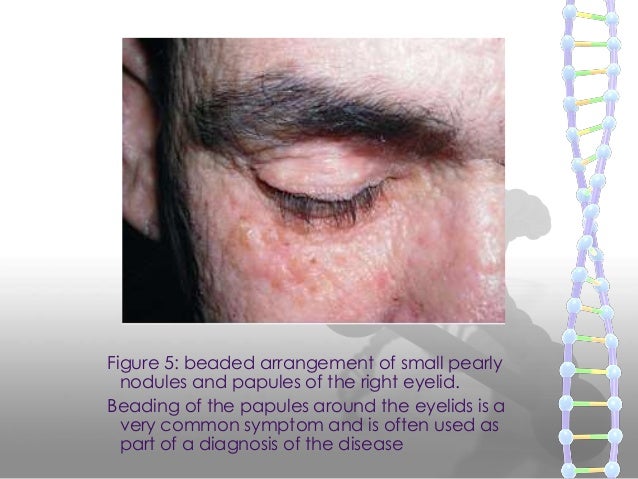 Urbach-Wiethe Syndrome Associated Fear Processing Defect