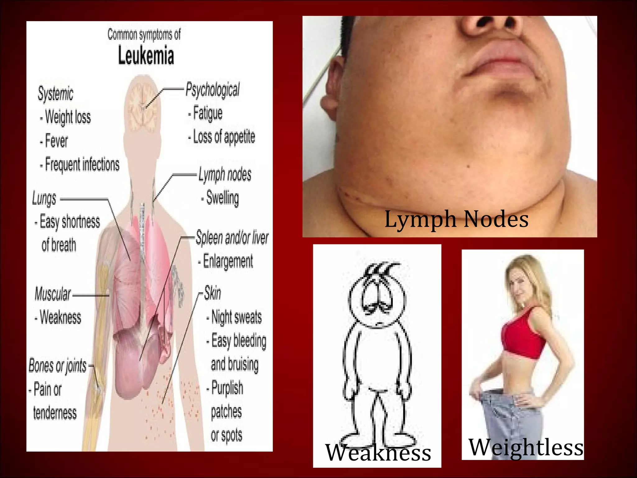 Lymph Nodes
Weakness Weightless
 