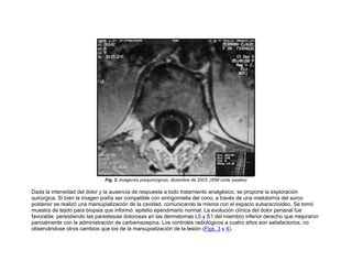Fig. 2. Imágenes prequirúrgicas, diciembre de 2003. (IRM corte axiales)

Dada la intensidad del dolor y la ausencia de respuesta a todo tratamiento analgésico, se propone la exploración
quirúrgica. Si bien la imagen podía ser compatible con siringomielia del cono, a través de una mielotomía del surco
posterior se realizó una marsupialización de la cavidad, comunicando la misma con el espacio subaracnoideo. Se tomó
muestra de tejido para biopsia que informó: epitelio ependimario normal. La evolución clínica del dolor perianal fue
favorable, persistiendo las parestesias dolorosas en las dermatomas L5 y S1 del miembro inferior derecho que mejoraron
parcialmente con la administración de carbamazepina. Los controles radiológicos a cuatro años son satisfactorios, no
observándose otros cambios que los de la marsupialización de la lesión (Figs. 3 y 4).
 